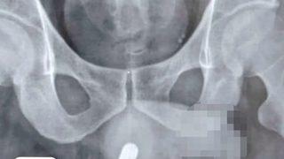 İnanılır gibi değil! Sosyal medyada görünce cinsel organında denedi, soluğu hastanede aldı