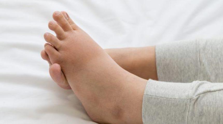 Bazı hastalıkların habercisi olabilen ödemi hafife almayın! İşte vücutta ödem oluşmasına sebep olan şeyler...