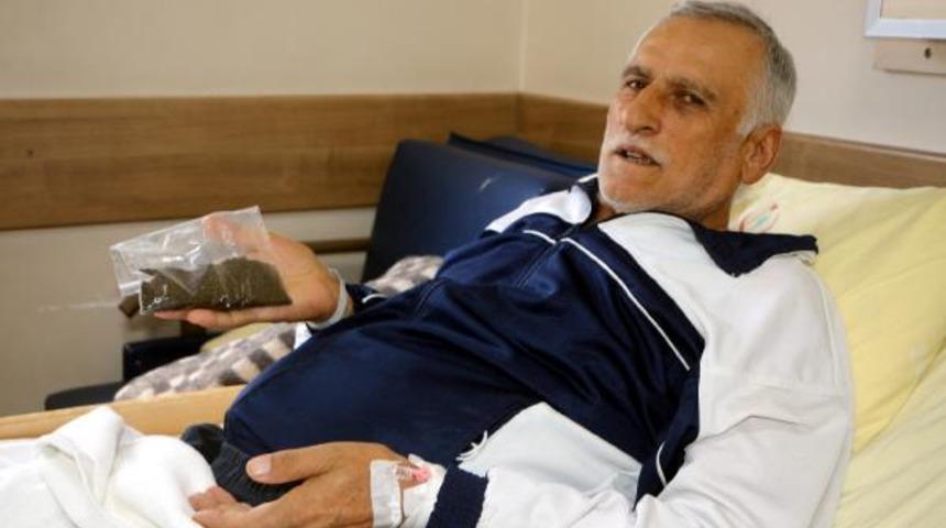 Safra kesesinden 14 bin 387 taş çıktı! Noter eşliğinde sayılıp Guinness'e başvuru yapıldı