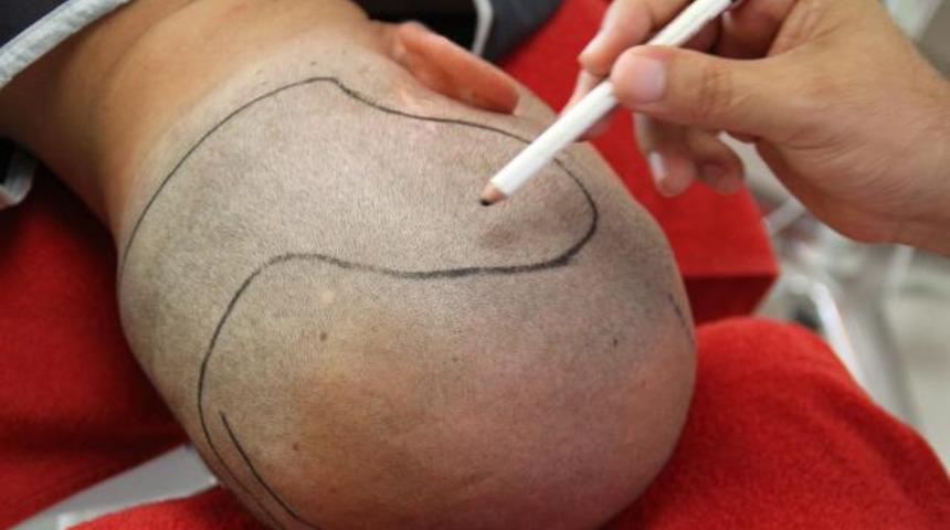 Sa&ccedil; ekimi sonrası  bakım