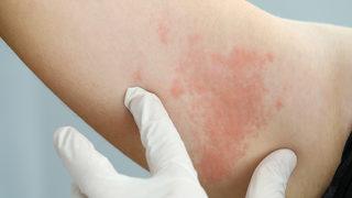 Bağışıklık sisteminin düşmesi zonaya neden oluyor