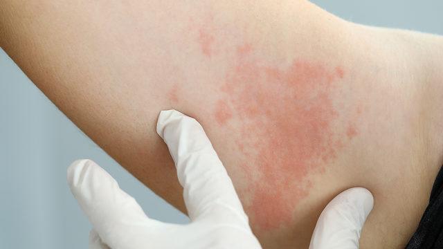 Bağışıklık sisteminin düşmesi zonaya neden oluyor