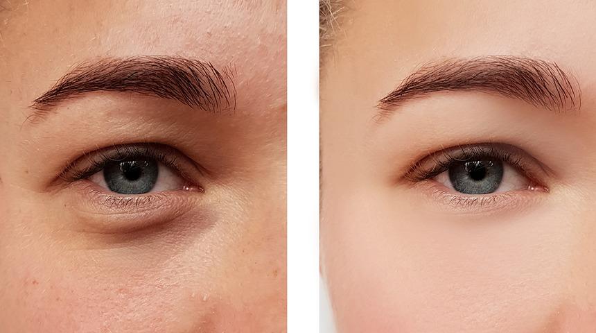 Göz çevresi sorunlarının çözümü...