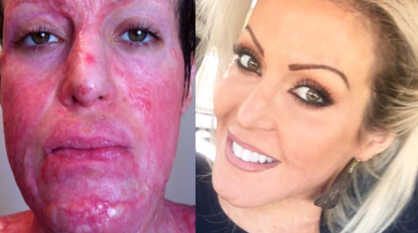 Kıskanç eş üzerine isporto döküp yakmıştı! 10 yıl sonraki halini görenler tanıyamadı