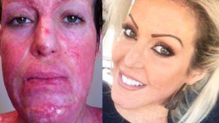 Kıskanç eş üzerine isporto döküp yakmıştı! 10 yıl sonraki halini görenler tanıyamadı