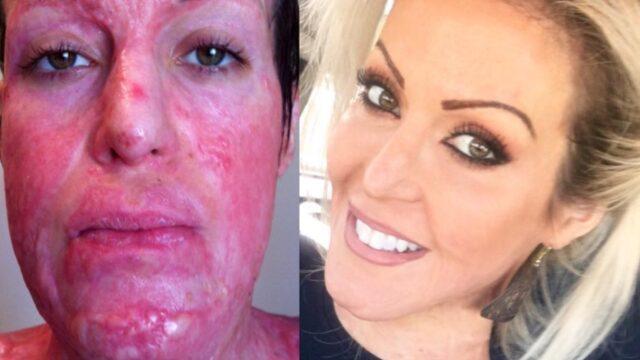 Kıskanç eş üzerine isporto döküp yakmıştı! 10 yıl sonraki halini görenler tanıyamadı