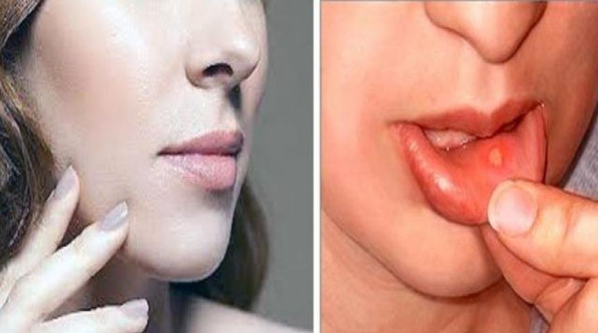 Ağız yaraları &ouml;l&uuml;me bile g&ouml;t&uuml;rebilir