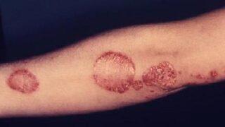 Sedef hastalığını dert etmeyin