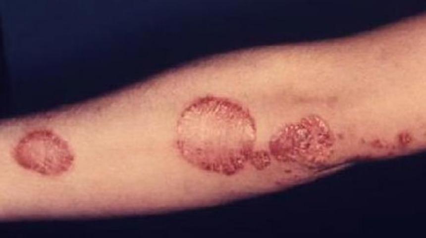 Sedef hastalığını dert etmeyin