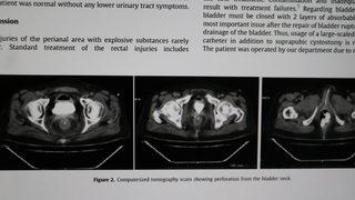 Böylesi görülmedi, tıp literatürüne girdi! Makatına yerleştirip patlattı... Daha önce de kendi penisini kesmiş