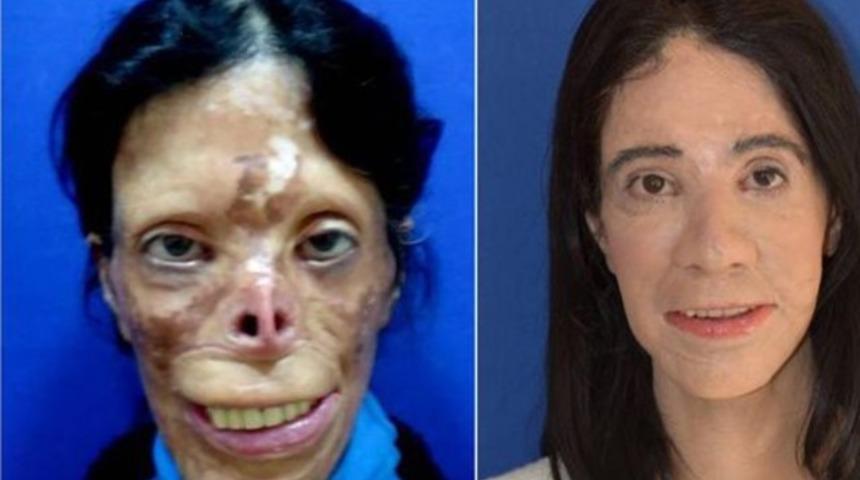 Kendi dokusundan yüz yapıldı