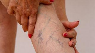 Varisin nedenleri ve belirtileri nelerdir? İşte tedavisi…