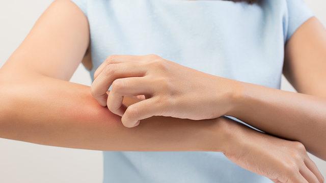 İyileşmeyen hastalar var: Covid-19 uyuz vakalarını patlattı! Uyuz hastalığı nedir, belirtileri nelerdir? Uyuz hastalığından nasıl korunulur?