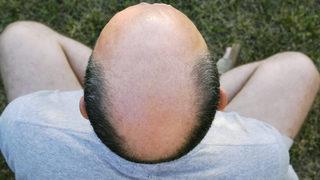 Saç ekimi yaptırmak için en uygun yaş nedir?