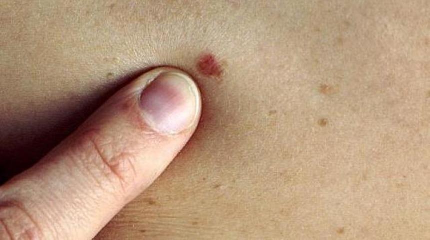 Deri kanseri g&ouml;r&uuml;lme sıklığı