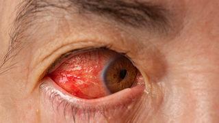 Sessizce ilerliyor, zamanında müdahale edilmezse kör kalabilirsiniz! Glokom nedir, belirtileri nelerdir?