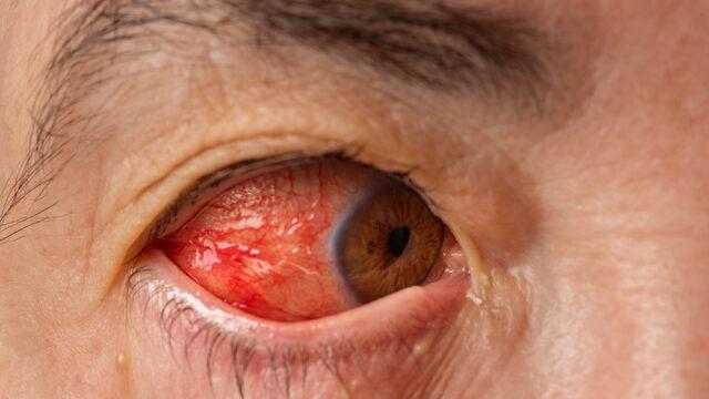 Sessizce ilerliyor, zamanında müdahale edilmezse kör kalabilirsiniz! Glokom nedir, belirtileri nelerdir?