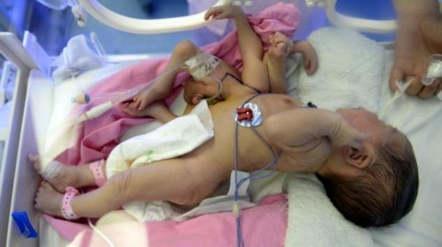 4 ayaklı ve 4 elli bebek doğdu