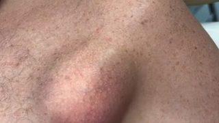 İzlenmesi 10 milyonu geçti! Görenin midesi bulandı: Epidermal kisti 'badem ezmesi' gibi sıktı!  