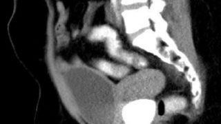 Röntgeni görenin ağzı açık kaldı! Cinsel organından çıkanlar şaşkınlık yarattı