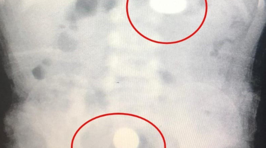 Madeni para yutan Murat bebek hastanelik oldu! Biri midesinde, diğeri yemek borusunda