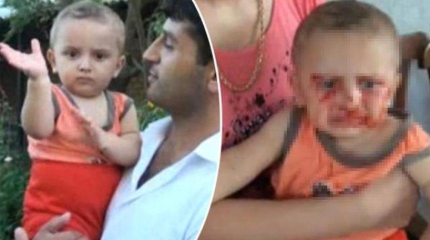 Uyuyunca gözlerinden kan geliyor!