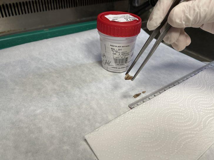 Kanser sanılan hastanın soluk borusundan badem zarı çıkarıldı G2