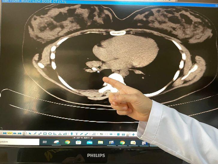 Kanser sanılan hastanın soluk borusundan badem zarı çıkarıldı G4