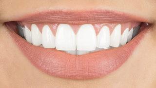 Sarı dişlere son! Anında beyazlatıyor