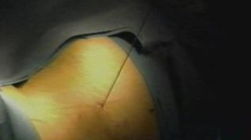 Lazer İle Ameliyatsız Bel Ve Boyun Fıtığı Tedavisi (Lazer Tedavisi)