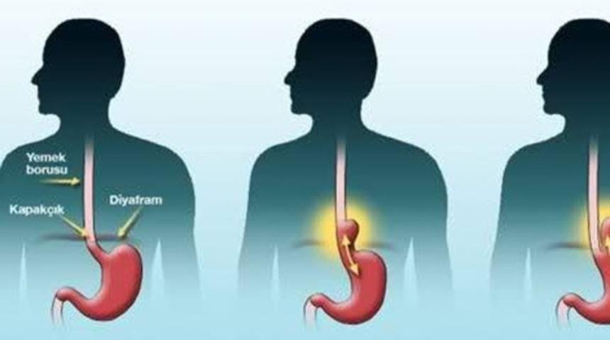 Gastroskopi nasıl yapılır?