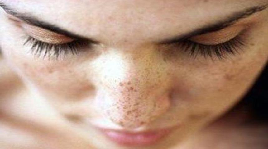 Cilt kanserine davetiye &ccedil;ıkarmayın!