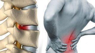 MISS nedir? (Bel Fıtığı, Boyun Fıtığı, Omurga Tedavisi)