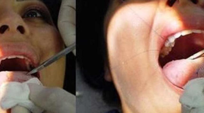 Yeni zayıflama y&ouml;ntemi: dile yama