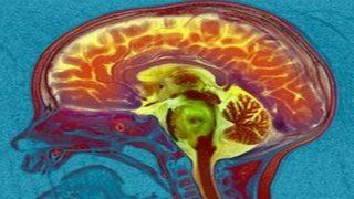 Beyin taramasıyla disleksiye erken teşhis