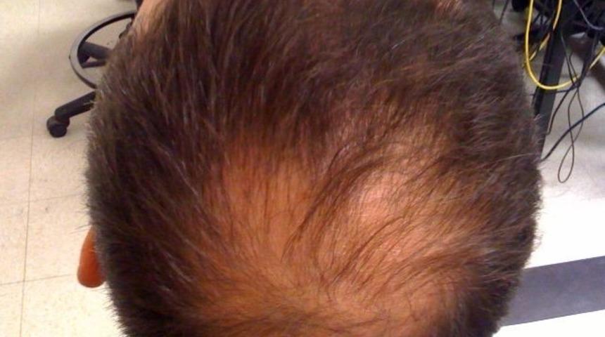 T&uuml;rkiye&rsquo;de sa&ccedil; d&ouml;k&uuml;lme oranı gittik&ccedil;e artıyor