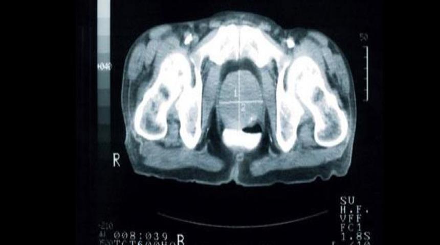 Kanserin fotoğrafını &ccedil;ekti