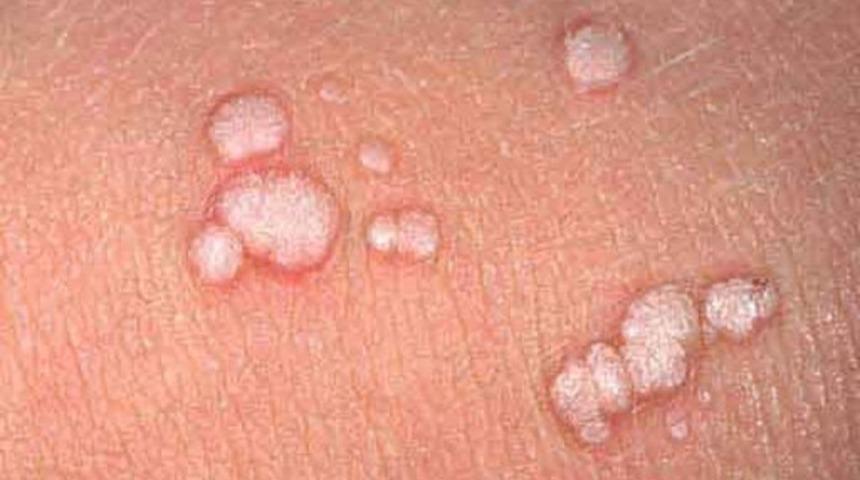 Genital siğil kansere d&ouml;n&uuml;şebilir