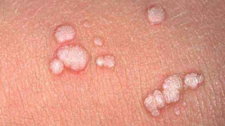 Papilloma nasıl çıkarılır En popüler yöntemler Papilloma nasıl çıkarılır En popüler yöntemler