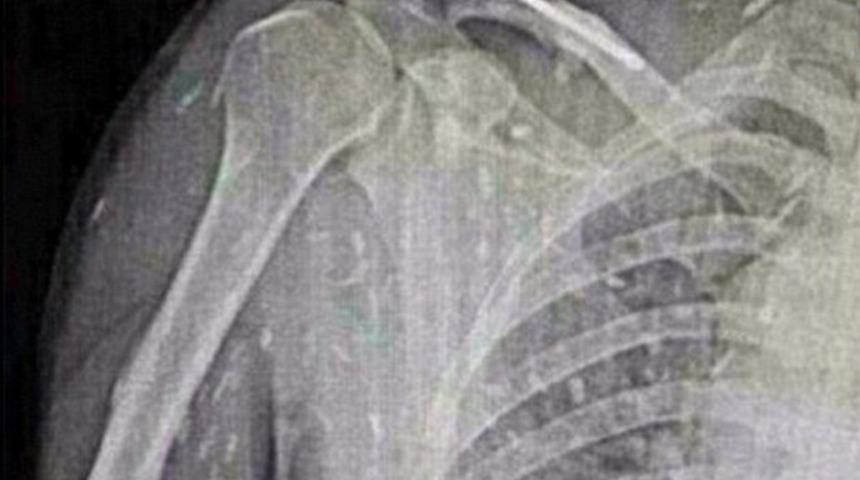 Suşi yüzünden tüm vücudunu tenya sardı