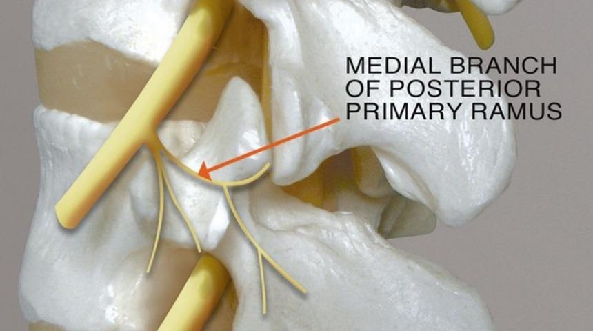 Faset Sendromu Faset Eklem Sendromu Tedavisi Bel Ve Boyun Ağrısı