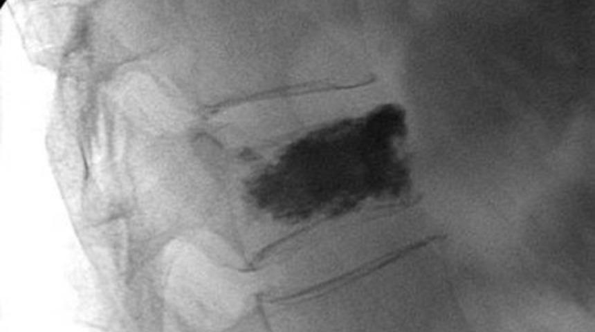 Vertebroplasti Nedir? Kifoplasti Nedir? Omurga Kırığı - Bel Kemiği Kırığı