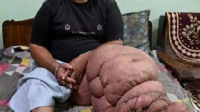 Sadece bir bacağı 98 kiloydu! Trafik kazasından sonra 10 yıl yatağa bağımlı olan adam yeniden yürümeye başladı