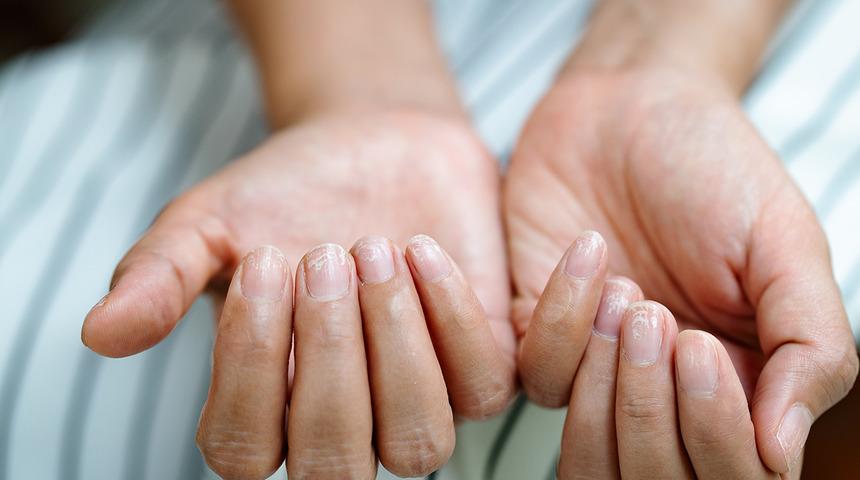 Tırnaklarınızda oluşan beyaz lekelerin nedeni hastalık olabilir! 