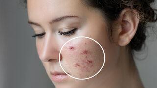 Sivilce izlerini geçirmek için yapılması gerekenler