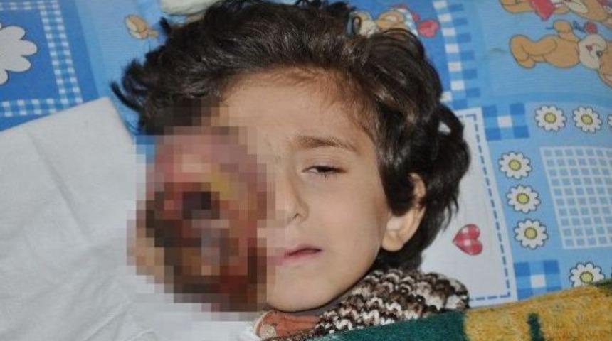 Yüzünde ur çıkan minik Muhammed yardım bekliyor