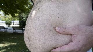 Tüp mide ameliyatı sonrası cinsel ilişkiye girilir mi? Tüp mide ameliyatı sonrası beslenme nasıl olmalı?