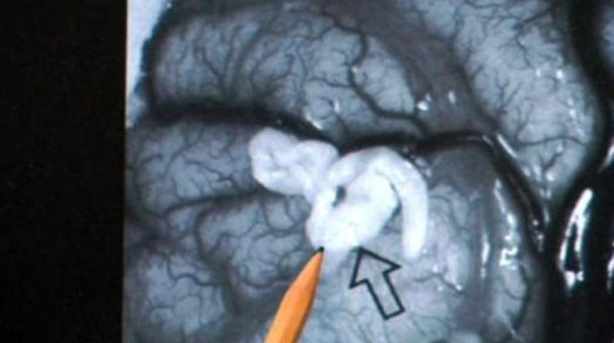 Beyninden tenya çıktı