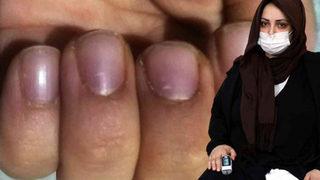 Her şey 3. doğumdan sonra başladı... Elleri, ayakları ve dudakları morarıyor! Benim yaşadığım hastalığın adı bile yok