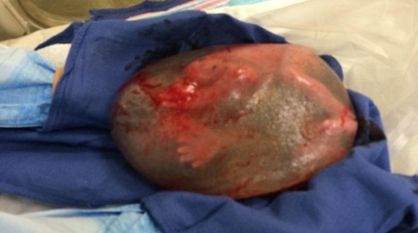 Mucize bebek b&ouml;yle doğdu